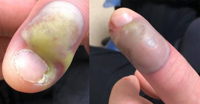 Paralajmërim: Kafshimi i thonjve mund t’iu kushtojë me jetë