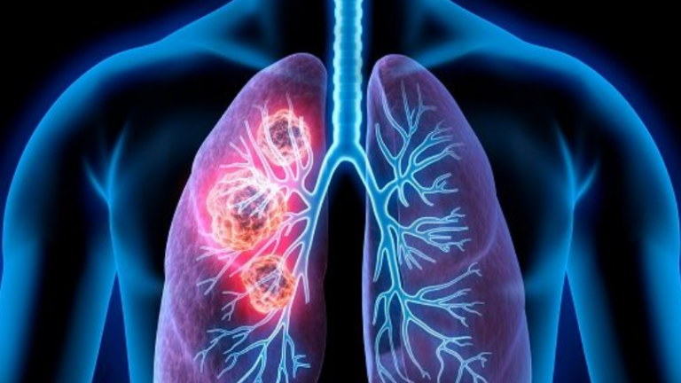 Pas cigareve, ja shkaktari kryesor i kancerit te mushkërive – sa i ekspozoheni