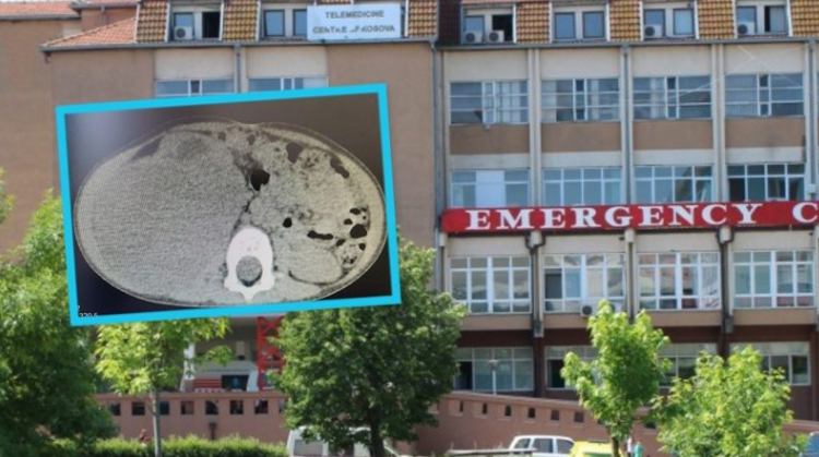 Operohet me sukses një fëmijë 2 vjeç në QKUK, i hiqet tumori me përmasa të mëdha