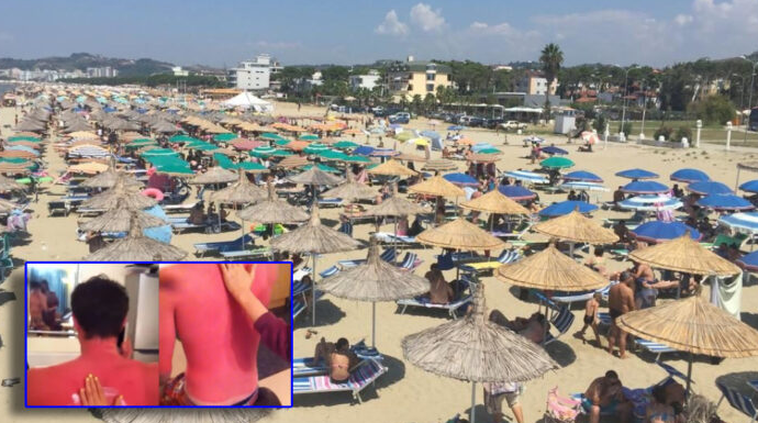E zuri gjumi në plazh, djaloshi bëhet “shkrum” nga dielli