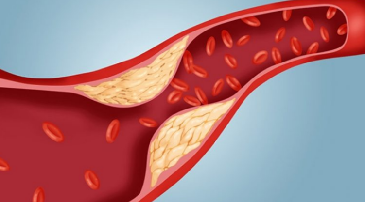 Këto janë disa nga faktorët që ndikojnë në rritjen e kolesterolit të keq dhe mënyrat për ta parandaluar