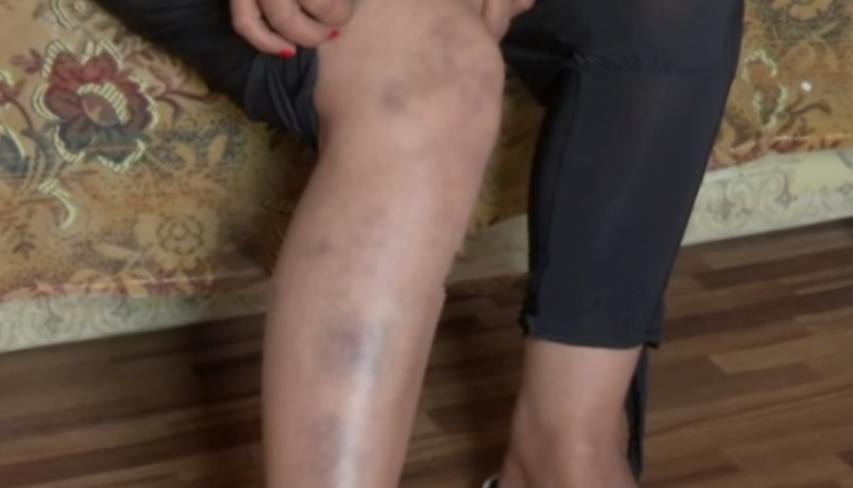 E rrahu dhe e djegu burri me cigare, gruaja kërkon ndihmë