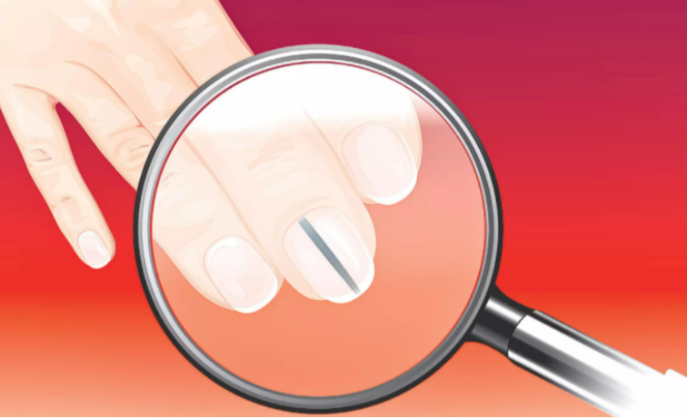 Kanceri: Shenjat e sëmundjes vdekjeprurëse që shfaqen shpesh në thonj