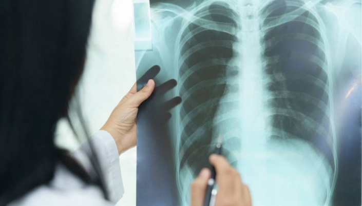 Një simptomë e fshehur që askush nuk do ta lidhë me kancerin e mushkërive