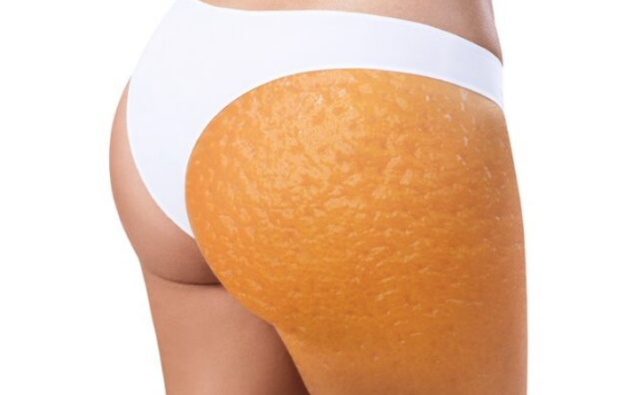 Pse meshkujt nuk kanë celulit?