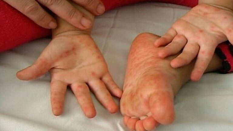 Krejt çka duhet të dini për virusin që po prek vetëm fëmijët e po përhapet me të madhe në Kosovë