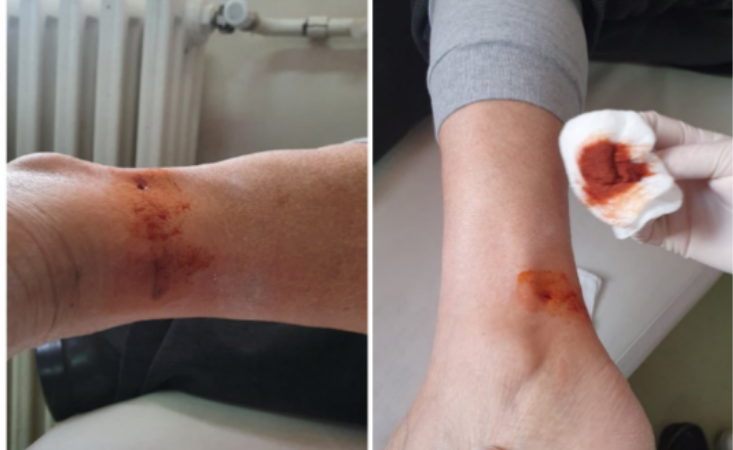 Qeni kafshon 70 vjeçarin, i moshuari bëhet për spital