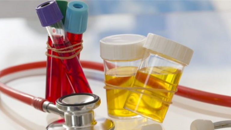 Më i rrezikshëm se kolesterina dhe sheqeri: Ky acid shkatërron në heshtje organet