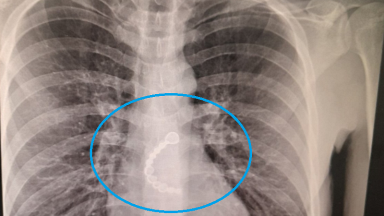 Ndodh edhe kjo: Një person gëlltiti dhëmbët teksa ishte në gjumë, mjeku në QKUK ia nxori