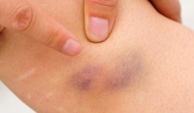 Çfarë paralajmërojnë mavijosjet e shpeshta në trup