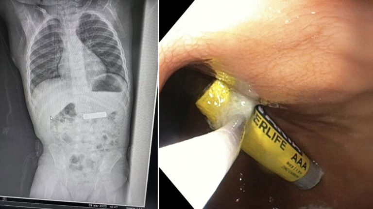Gastroenterologu kosovar shpëton fëmijën 2-vjeçar, ia heq baterinë e telekomandës nga stomaku