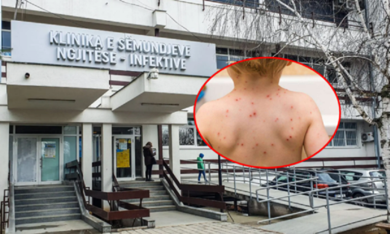 Dhjetë raste të fruthit, QKUK-prindërve: Mos bini pre e dezinformatave, vaksinoni fëmijët, rreziku i sëmundjes është i madh